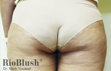 Cellulite marks after